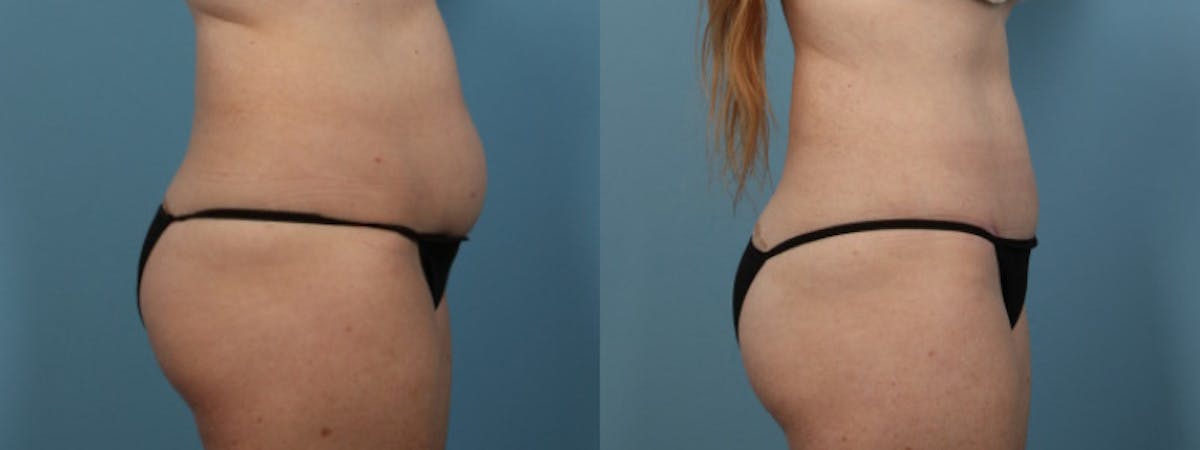 Tummy Tuck Before & After Gallery - Patient 282639 - Image 4