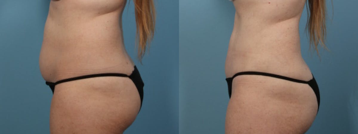 Tummy Tuck Before & After Gallery - Patient 282639 - Image 5