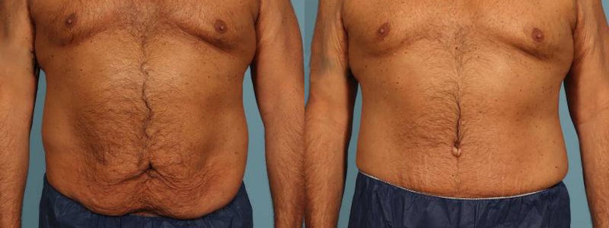 Tummy Tuck Before & After Gallery - Patient 538074 - Image 1