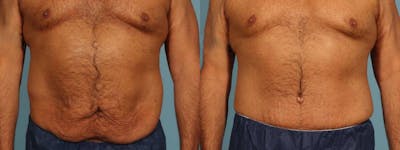 Tummy Tuck Before & After Gallery - Patient 538074 - Image 1