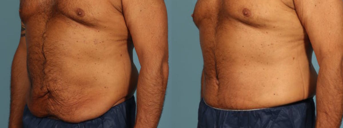 Tummy Tuck Before & After Gallery - Patient 538074 - Image 2