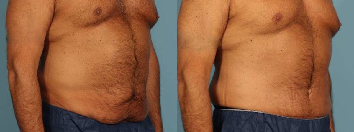 Tummy Tuck Before & After Gallery - Patient 538074 - Image 3