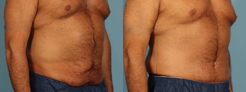 Tummy Tuck Before & After Gallery - Patient 538074 - Image 3
