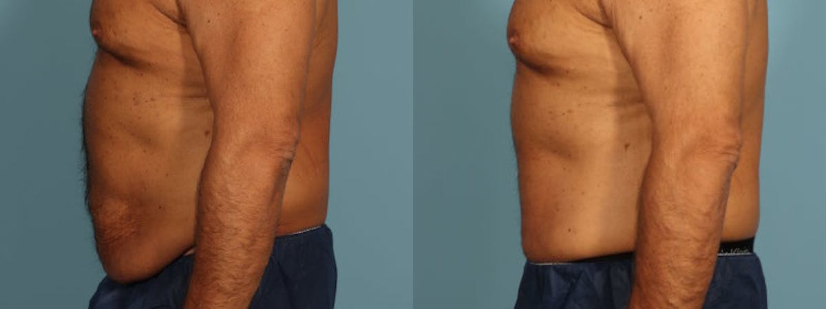 Tummy Tuck Before & After Gallery - Patient 538074 - Image 4