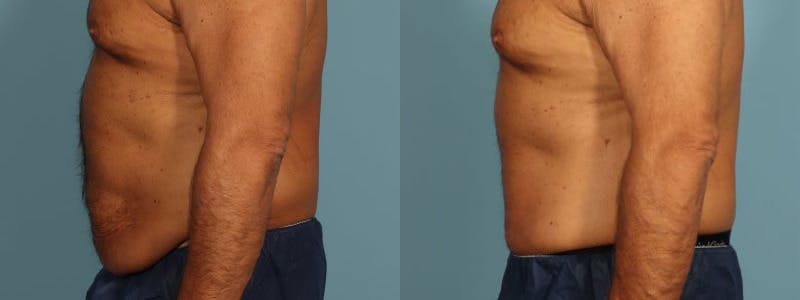 Tummy Tuck Before & After Gallery - Patient 538074 - Image 4