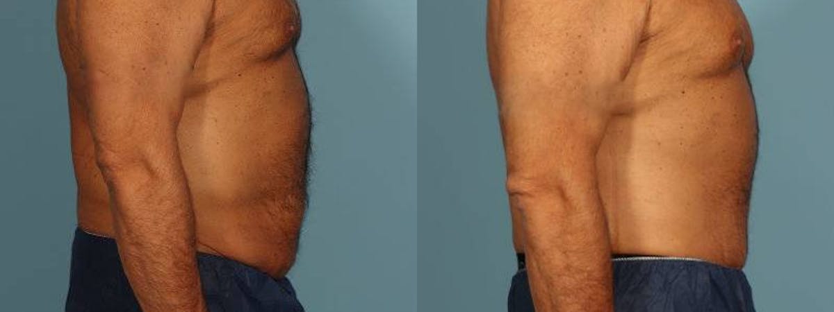 Tummy Tuck Before & After Gallery - Patient 538074 - Image 5