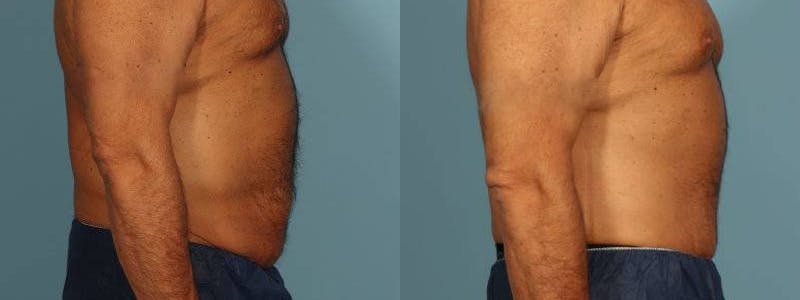 Tummy Tuck Before & After Gallery - Patient 538074 - Image 5
