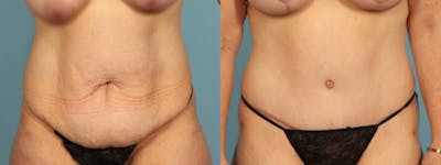 Tummy Tuck Before & After Gallery - Patient 134209 - Image 1