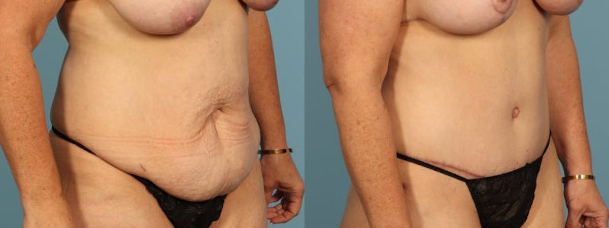 Tummy Tuck Before & After Gallery - Patient 134209 - Image 2