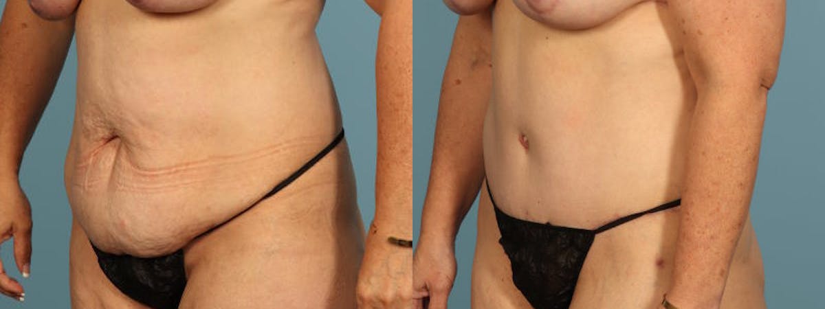 Tummy Tuck Before & After Gallery - Patient 134209 - Image 3