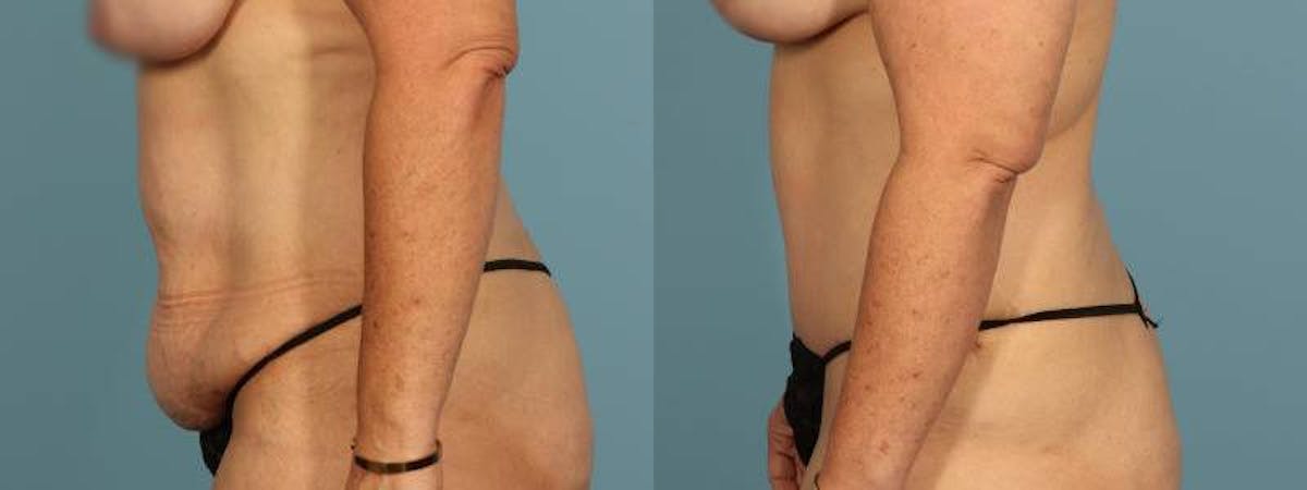 Tummy Tuck Before & After Gallery - Patient 134209 - Image 4
