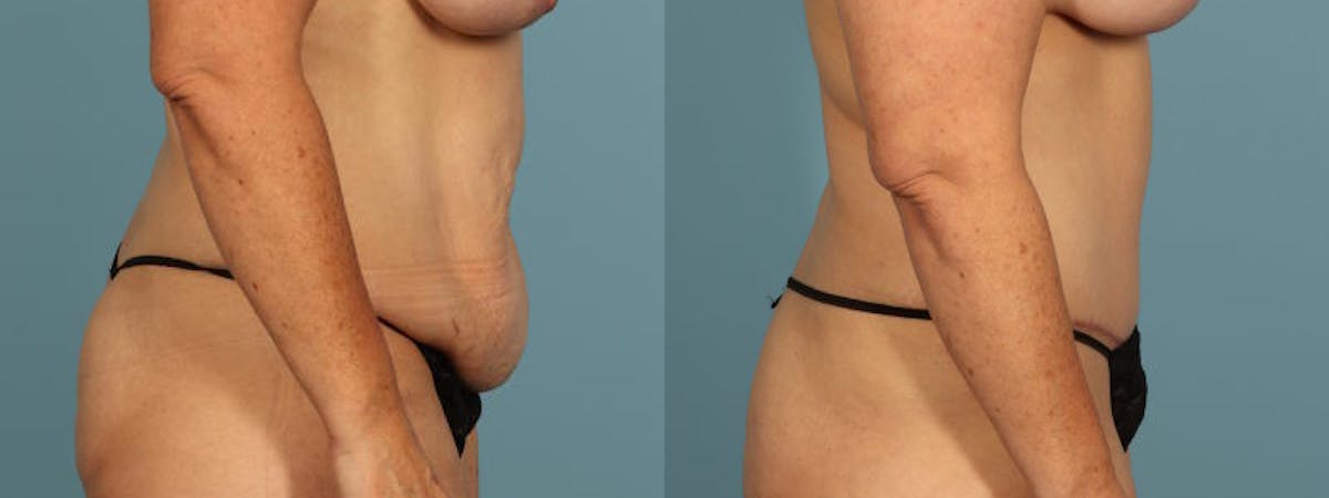 Tummy Tuck Before & After Gallery - Patient 134209 - Image 5