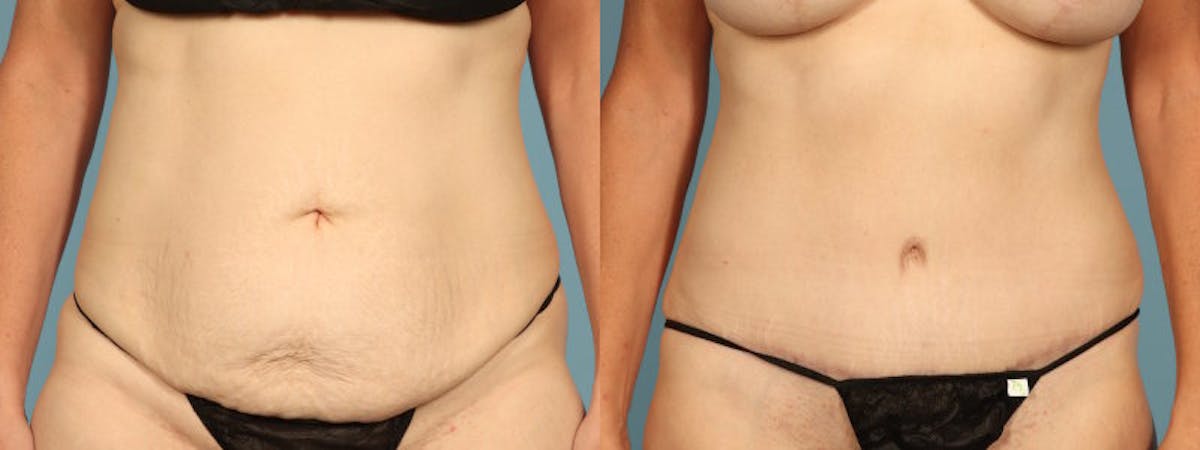 Tummy Tuck Before & After Gallery - Patient 198905 - Image 1