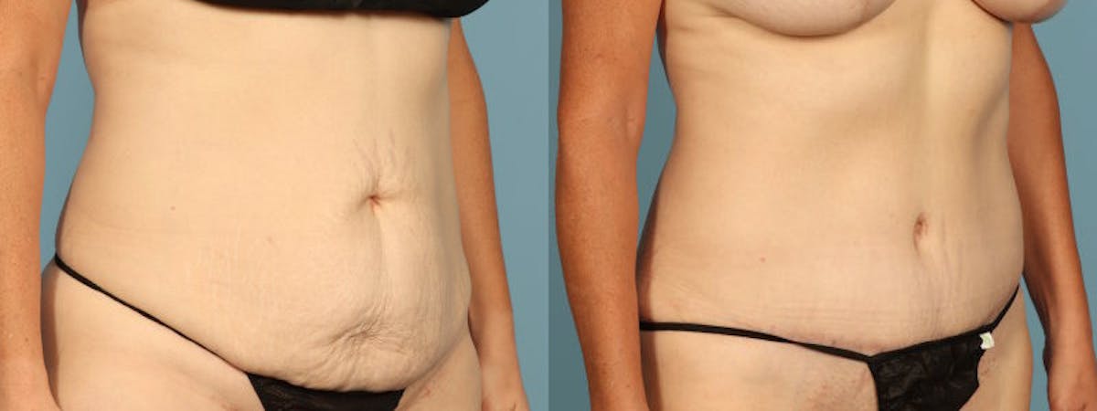 Tummy Tuck Before & After Gallery - Patient 198905 - Image 2