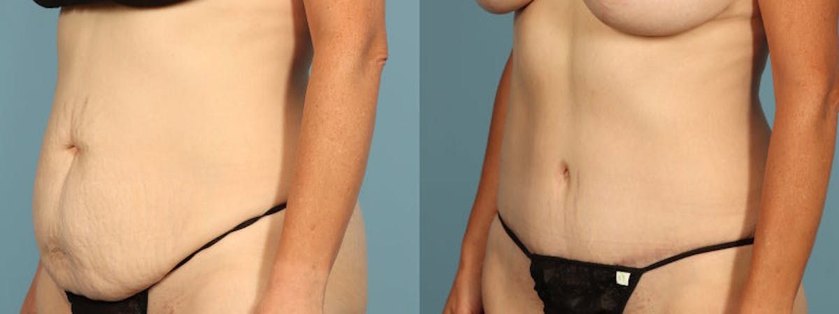 Tummy Tuck Before & After Gallery - Patient 198905 - Image 3