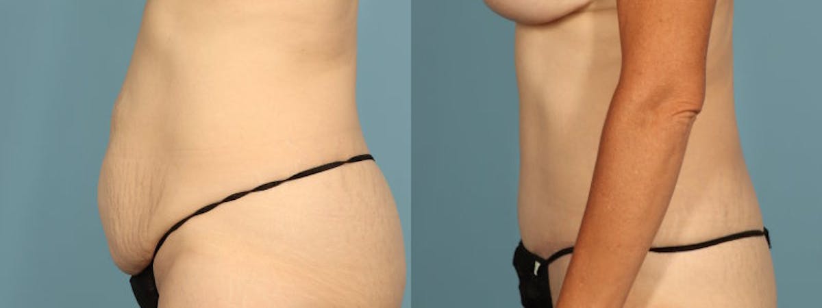 Tummy Tuck Before & After Gallery - Patient 198905 - Image 4
