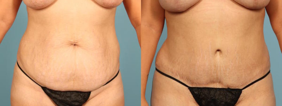Tummy Tuck Before & After Gallery - Patient 244454 - Image 1