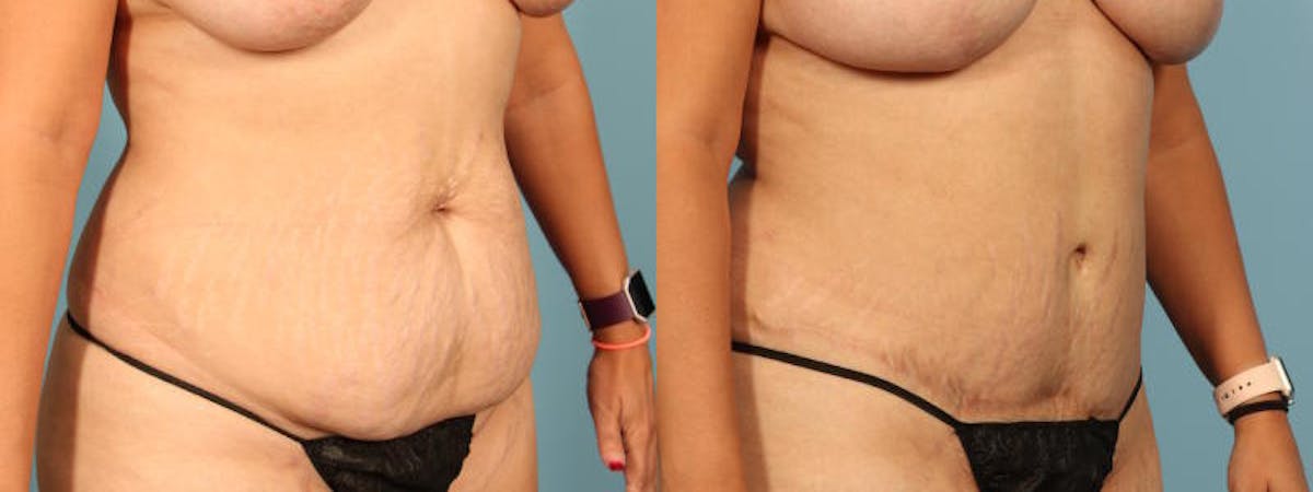 Tummy Tuck Before & After Gallery - Patient 244454 - Image 2