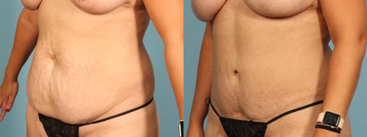 Tummy Tuck Before & After Gallery - Patient 244454 - Image 3