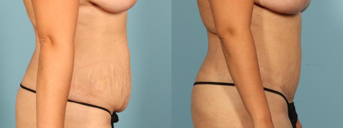 Tummy Tuck Before & After Gallery - Patient 244454 - Image 5