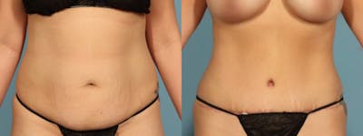 Tummy Tuck Before & After Gallery - Patient 242688 - Image 1