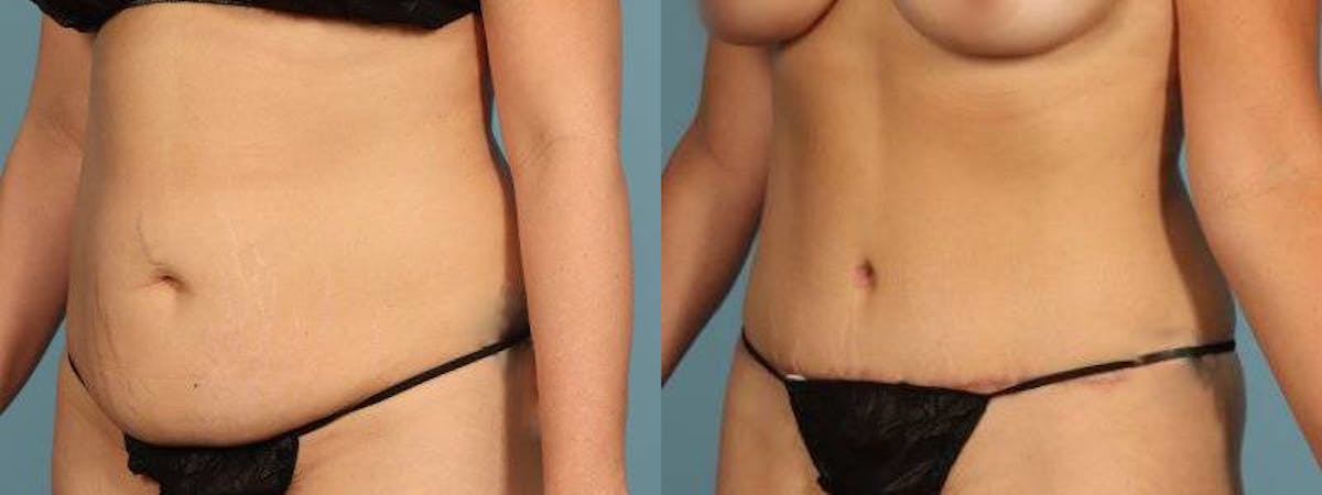 Tummy Tuck Before & After Gallery - Patient 242688 - Image 2