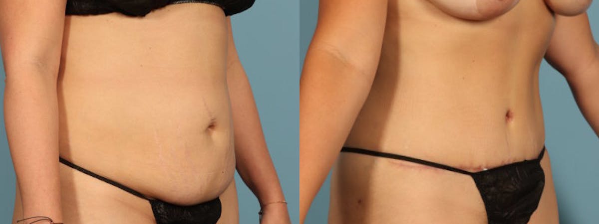 Tummy Tuck Before & After Gallery - Patient 242688 - Image 3