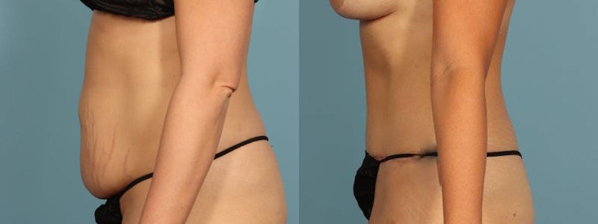 Tummy Tuck Before & After Gallery - Patient 242688 - Image 4