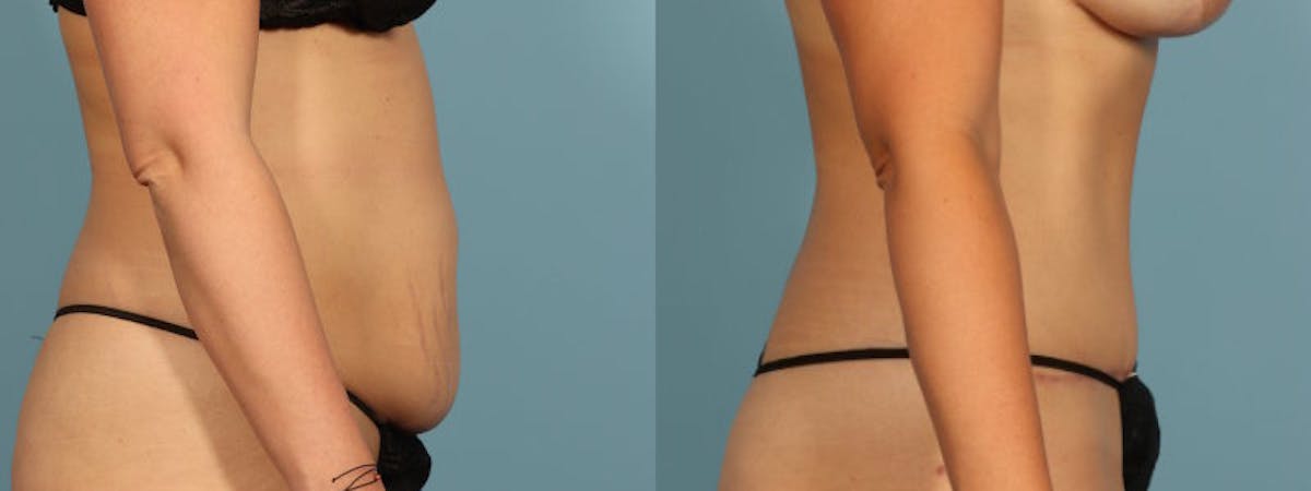 Tummy Tuck Before & After Gallery - Patient 242688 - Image 5