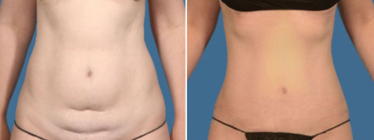 Tummy Tuck Before & After Gallery - Patient 381261 - Image 1