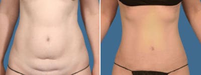 Tummy Tuck Before & After Gallery - Patient 381261 - Image 1