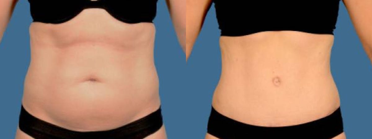 Tummy Tuck Before & After Gallery - Patient 296819 - Image 1