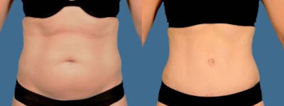 Tummy Tuck Before & After Gallery - Patient 296819 - Image 1
