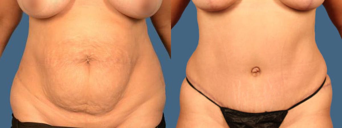 Tummy Tuck Before & After Gallery - Patient 551781 - Image 1