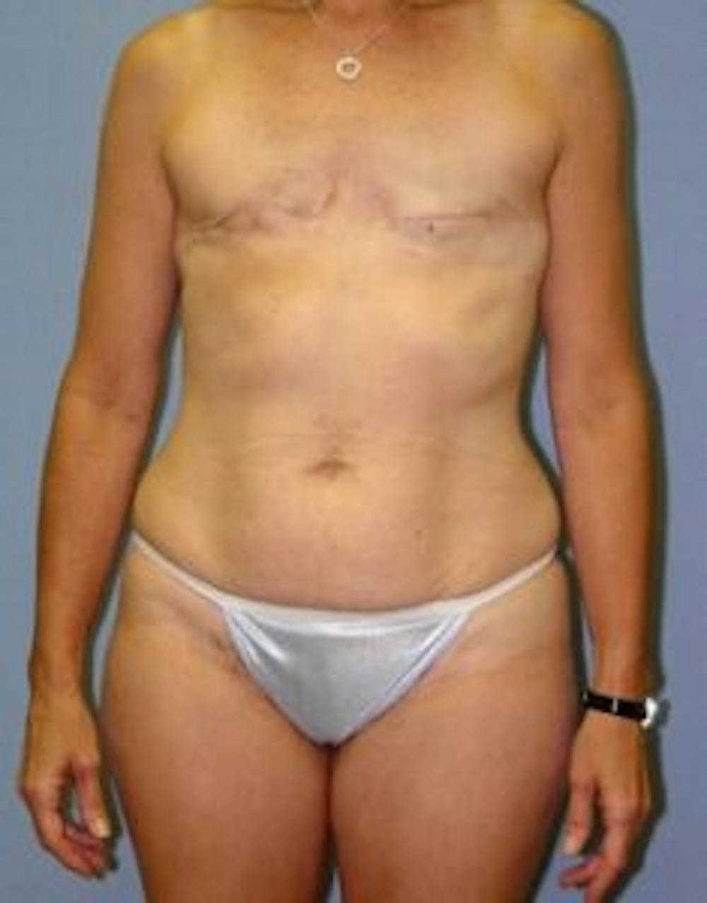 breast reconstruction patient