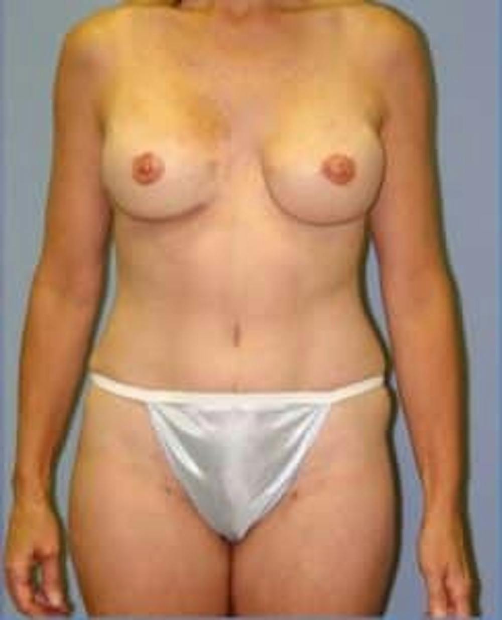 breast reconstruction patient