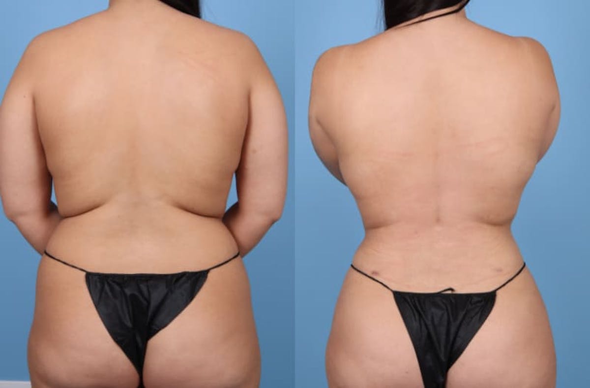 Liposuction Before & After Gallery - Patient 158855 - Image 1