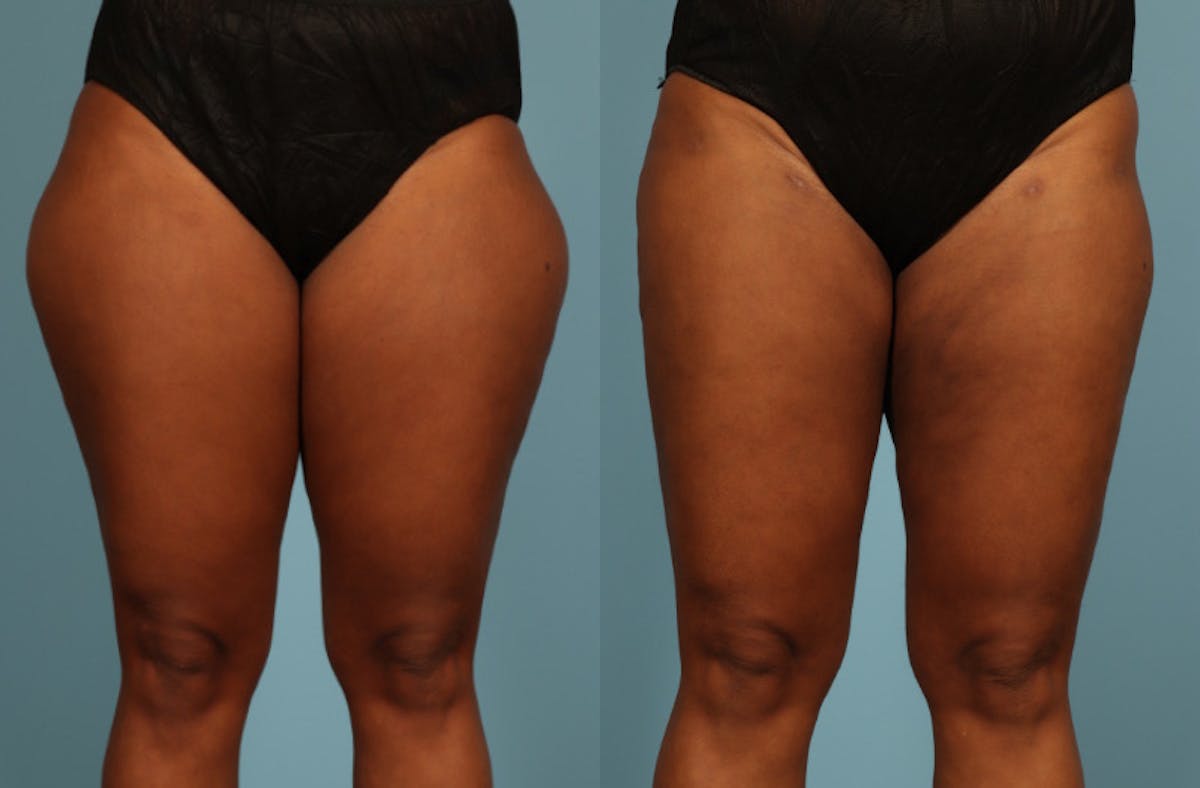 Liposuction Before & After Gallery - Patient 128901 - Image 1