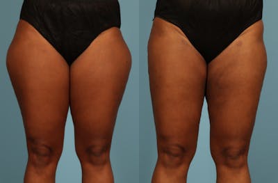 Liposuction Before & After Gallery - Patient 128901 - Image 1