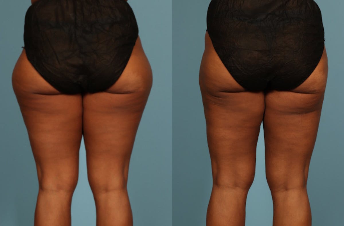 Liposuction Before & After Gallery - Patient 128901 - Image 2