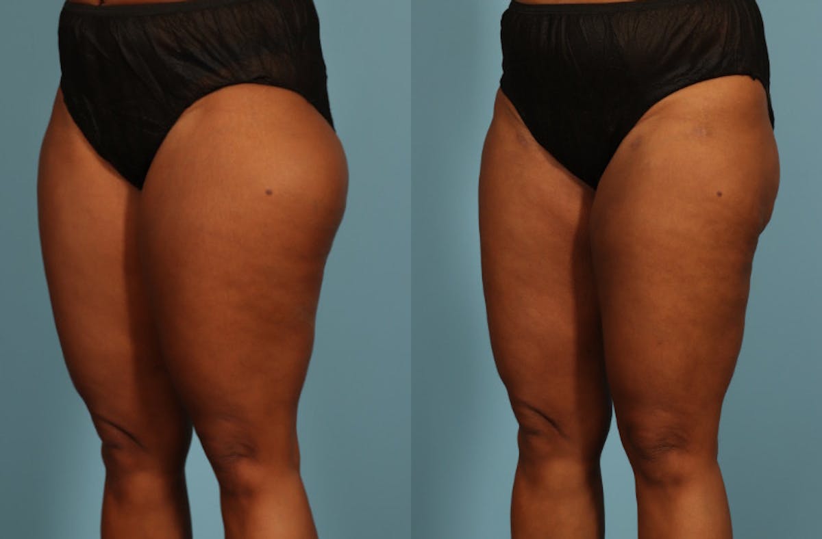 Liposuction Before & After Gallery - Patient 128901 - Image 3