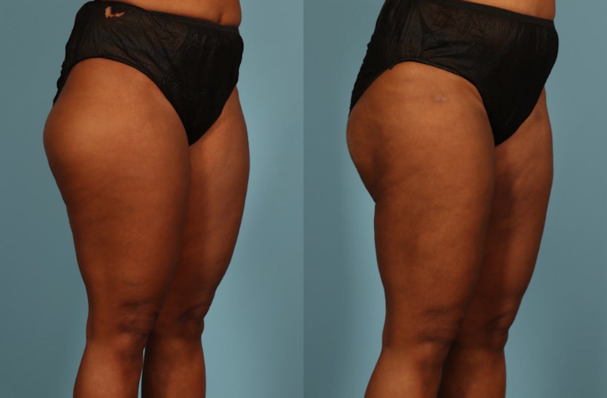 Liposuction Before & After Gallery - Patient 128901 - Image 4