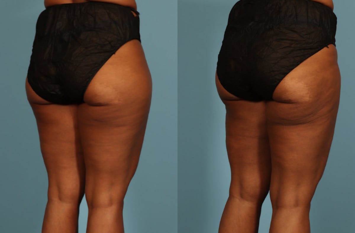 Liposuction Before & After Gallery - Patient 128901 - Image 5