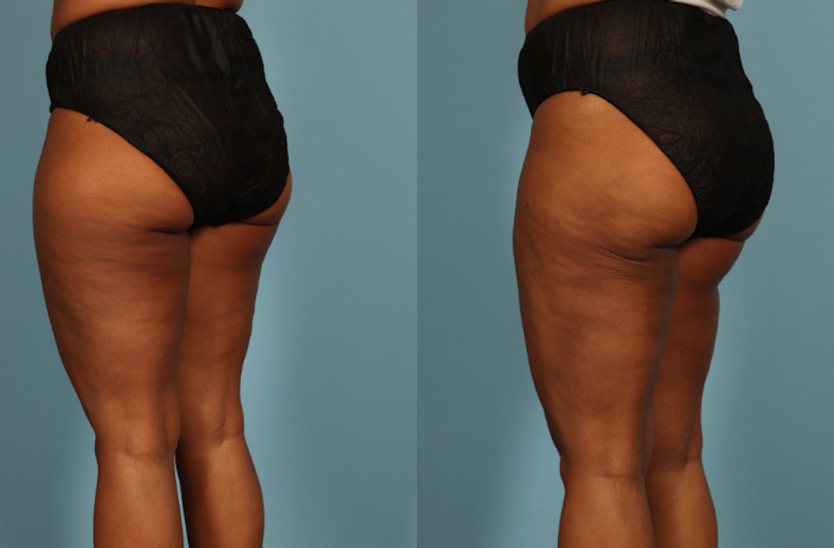 Liposuction Before & After Gallery - Patient 128901 - Image 6