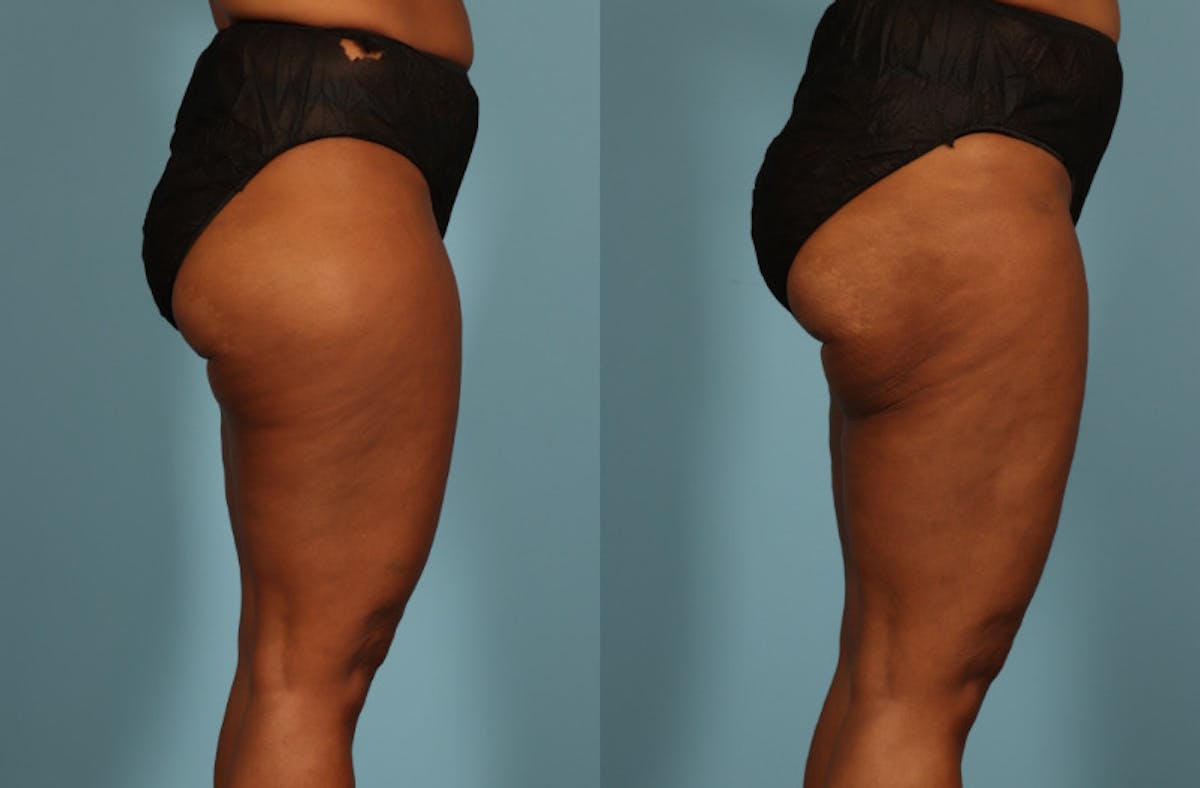 Liposuction Before & After Gallery - Patient 128901 - Image 7