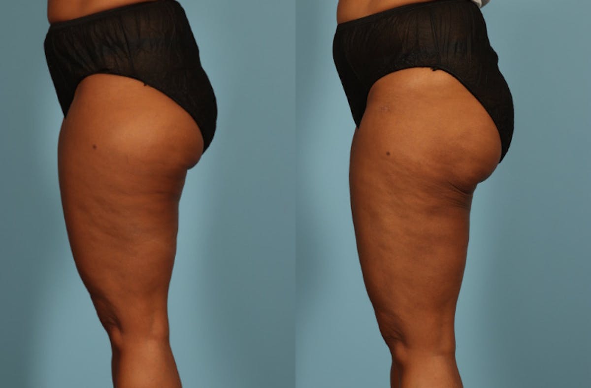Liposuction Before & After Gallery - Patient 128901 - Image 8