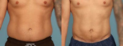 Liposuction Before & After Gallery - Patient 340300 - Image 1