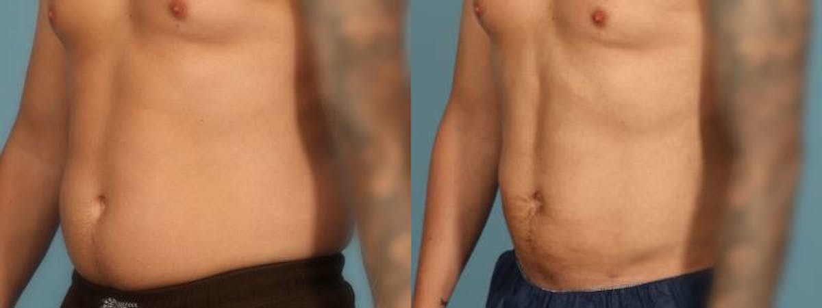 Liposuction Before & After Gallery - Patient 340300 - Image 2
