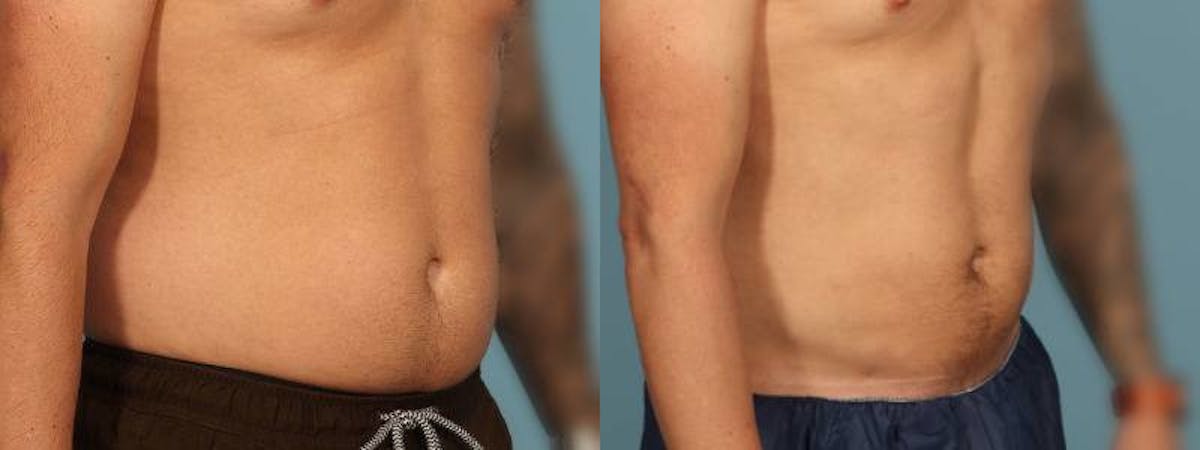 Liposuction Before & After Gallery - Patient 340300 - Image 3