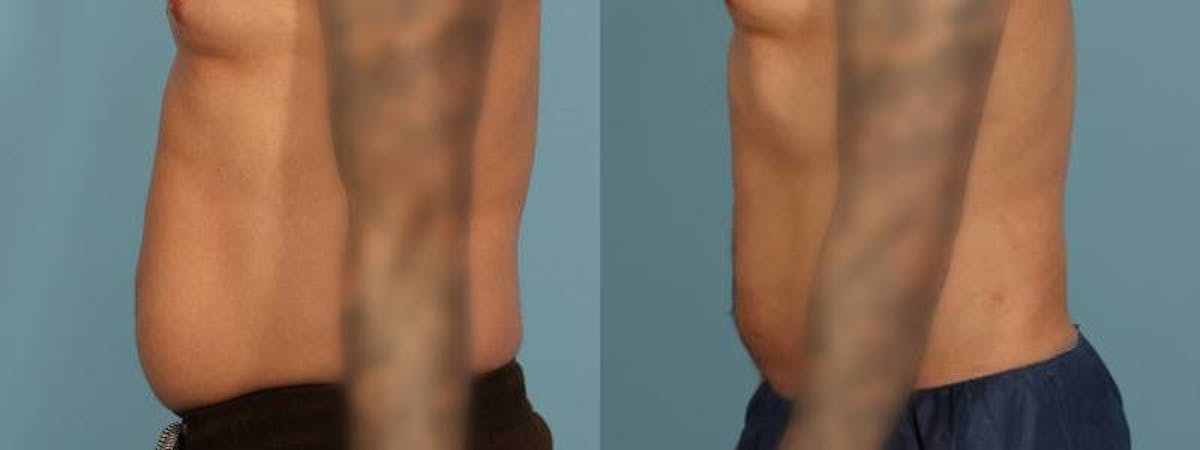 Liposuction Before & After Gallery - Patient 340300 - Image 4